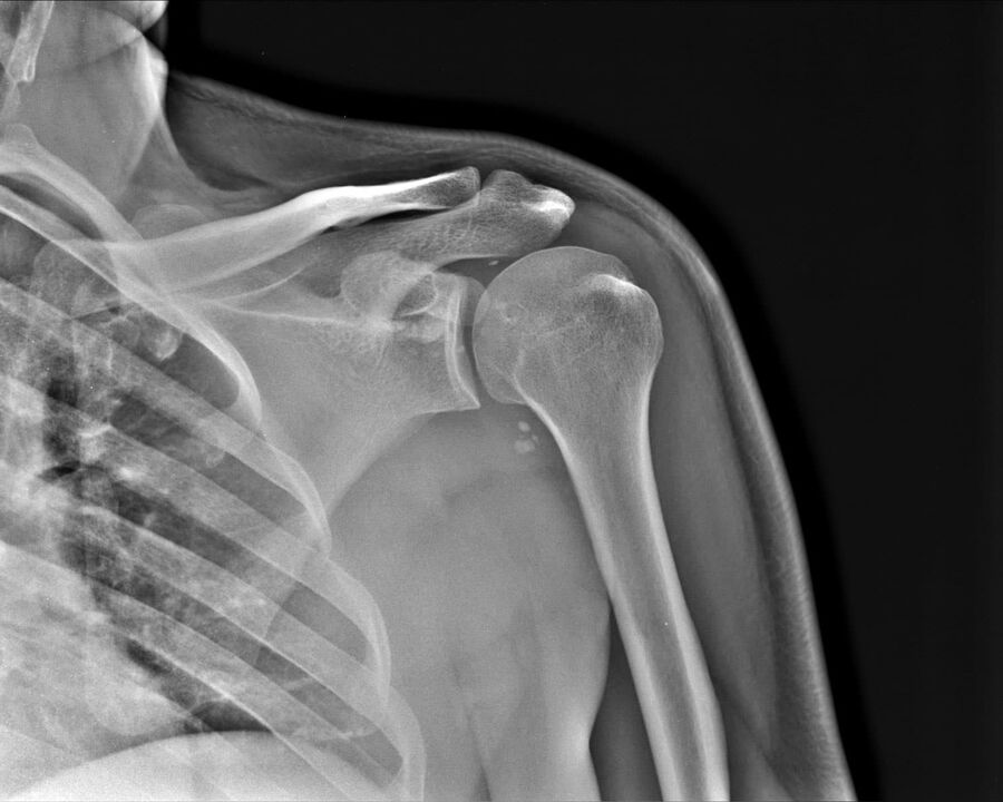 Röntgenbild einer Arthrose des Schultergelenks 2. Schweregrad