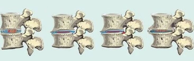 Wirbelsäulenläsion bei thorakaler Osteochondrose