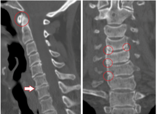 Der CT-Scan zeigt beschädigte Wirbel und Bandscheiben mit heterogener Höhe aufgrund von thorakaler Osteochondrose