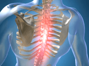 Wiederkehrende oder anhaltende schmerzende Schmerzen bei Osteochondrose in der Brust