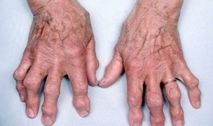 wie man Arthritis der Finger von Arthrose unterscheidet