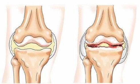 gesundes und von Arthrose betroffenes Kniegelenk