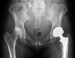 Diagnose einer Arthrose des Hüftgelenks