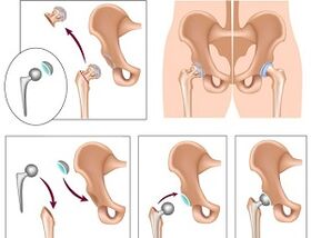 Endoprothetik bei Arthrose des Hüftgelenks