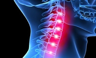 Manifestationen der Osteochondrose der Halswirbelsäule